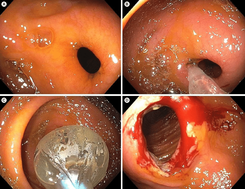 Antegrade-endoscopic-balloon-dilation-of-an-ileocolonic-anastomosis-stricture-in-CD-A