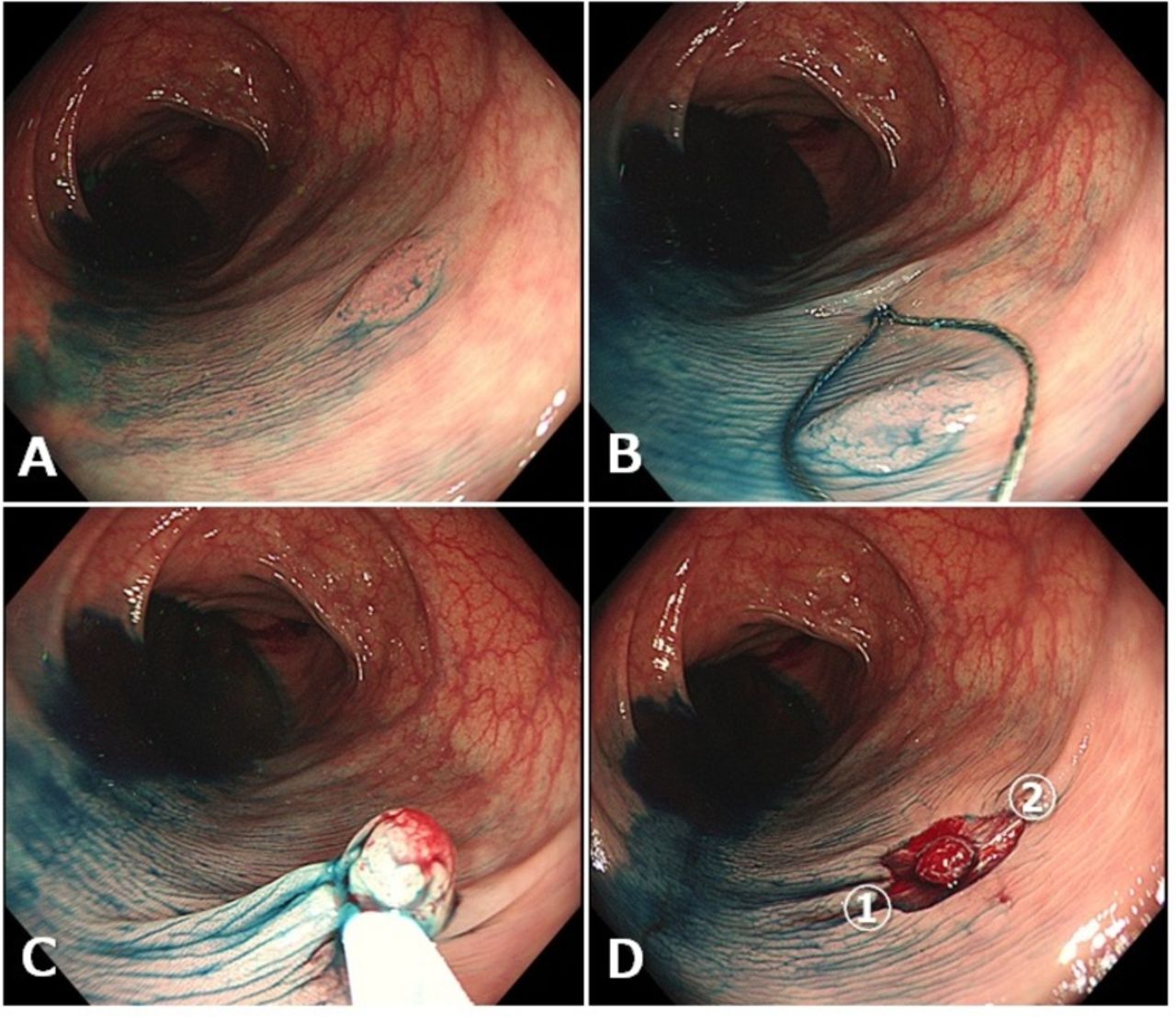 colonoscopy and polypectomy